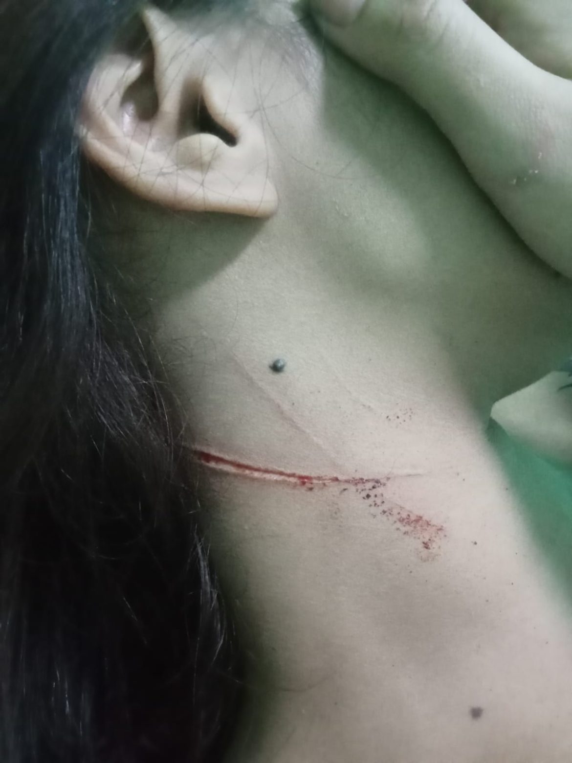 Pemandu Karaoke Dianiaya Pengunjung, Alami Luka Sayatan Di Leher